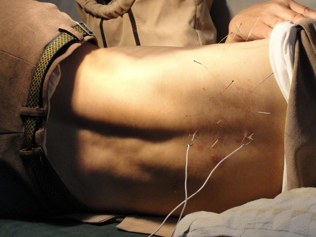 Acupuncturist in Lelystad die acupunctuurbehandeling uitvoert voor pijnverlichting en welzijn